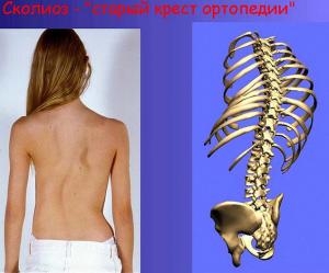 сколиоз,искревление позвоночника